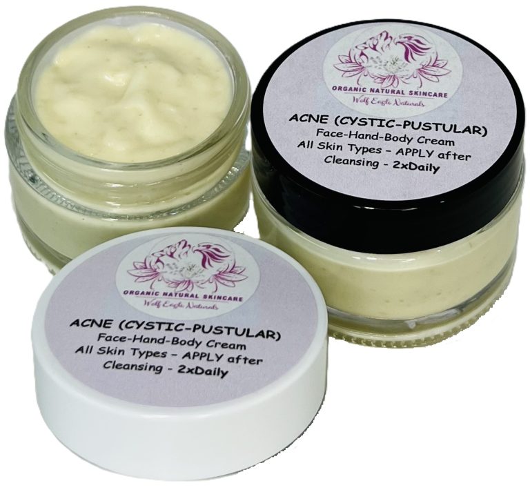 Acne (Cystic-Pustular) <br>Cream Acne (Cystic-Pustular) Cream